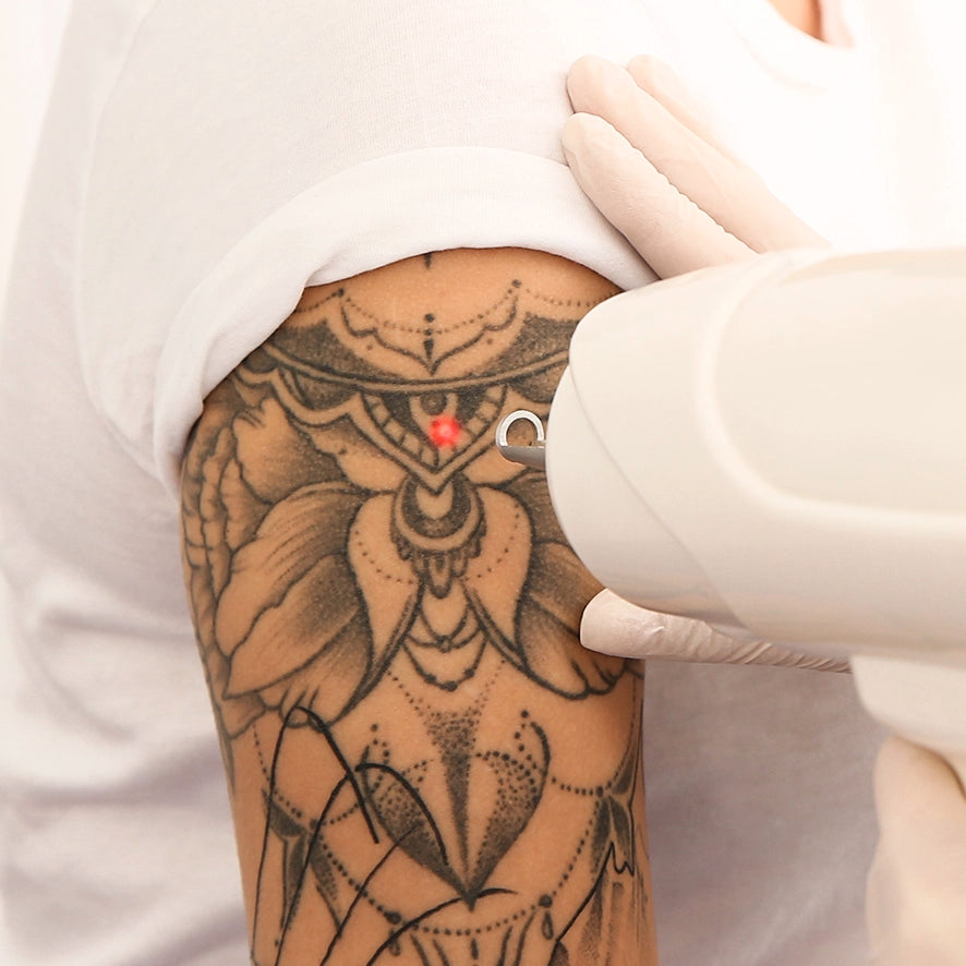 Tattoo removal - ND Yag Laser Treatment