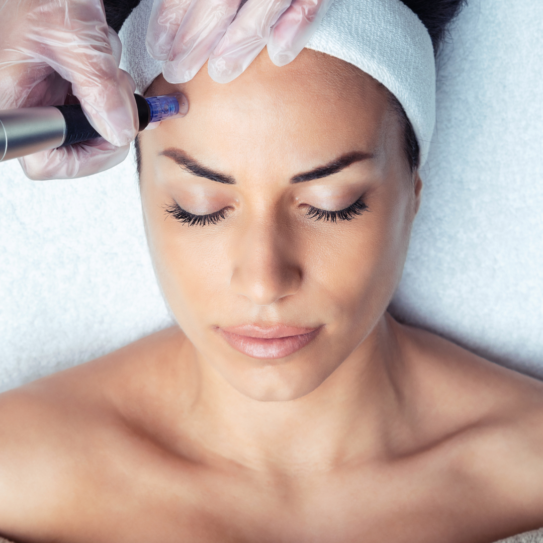 Uncovering the Transformative Benefits of Microneedling for Radiant Skin