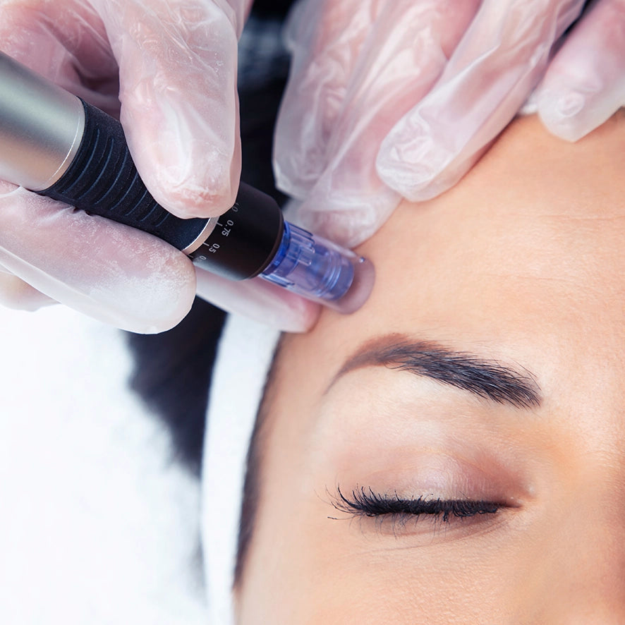 The Truth Behind Microneedling: A Buzzworthy Skin Procedure