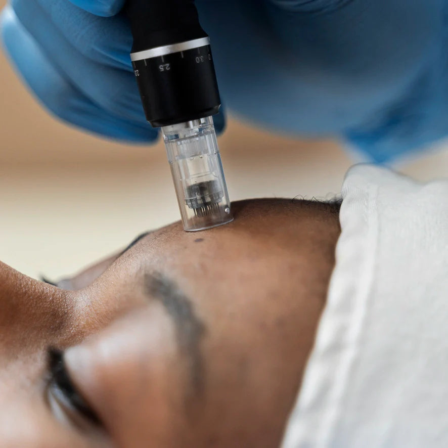 Microneedling: Scary or the Latest Miracle Skin Treatment?