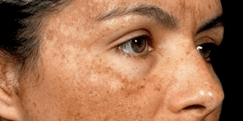 5 Facts you should know about Pigmentation!